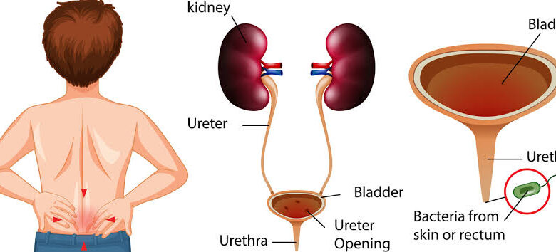 Kidney Infection and Urinary Tract Infection