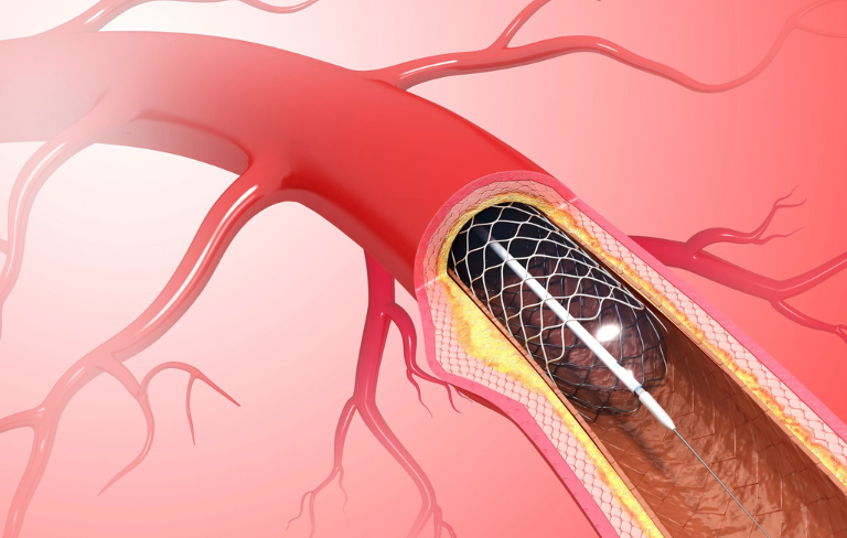 Peripheral Vascular Interventions