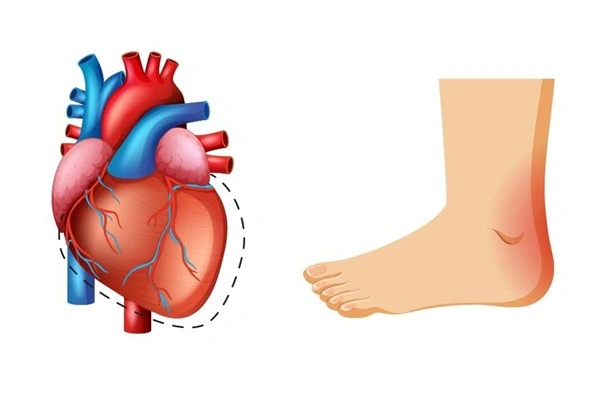 Swelling in Legs, Feet, or Ankles