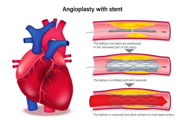 Symptoms and Treatments of Coronary Artery Disease (CAD)